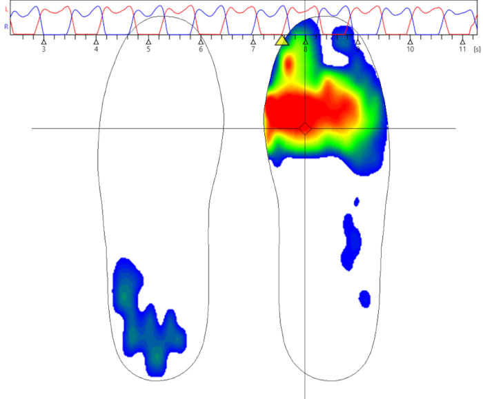 3D-Fußscan: Heatmap bei der digitalen Fußvermessung
